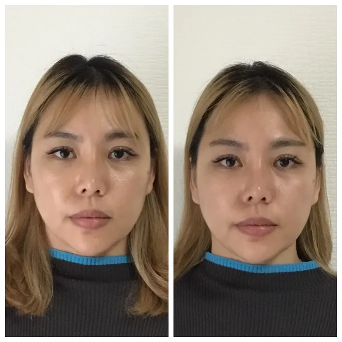 【美容鍼ってぶっちゃけどう？】1回でも効果あり