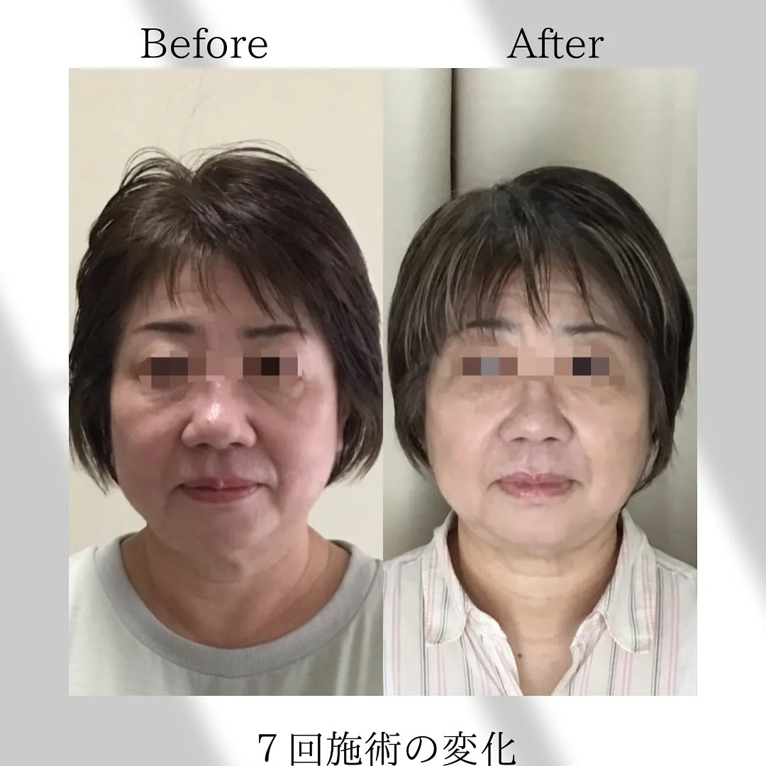 【美容鍼7回での変化！！】