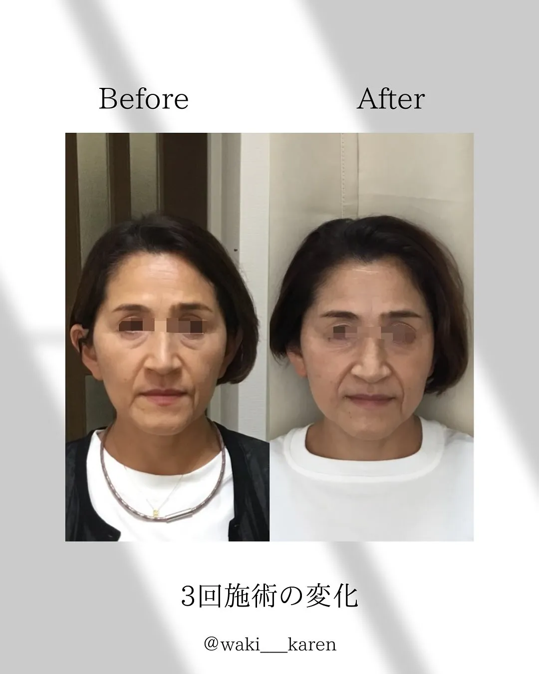 【美容鍼3回の効果】